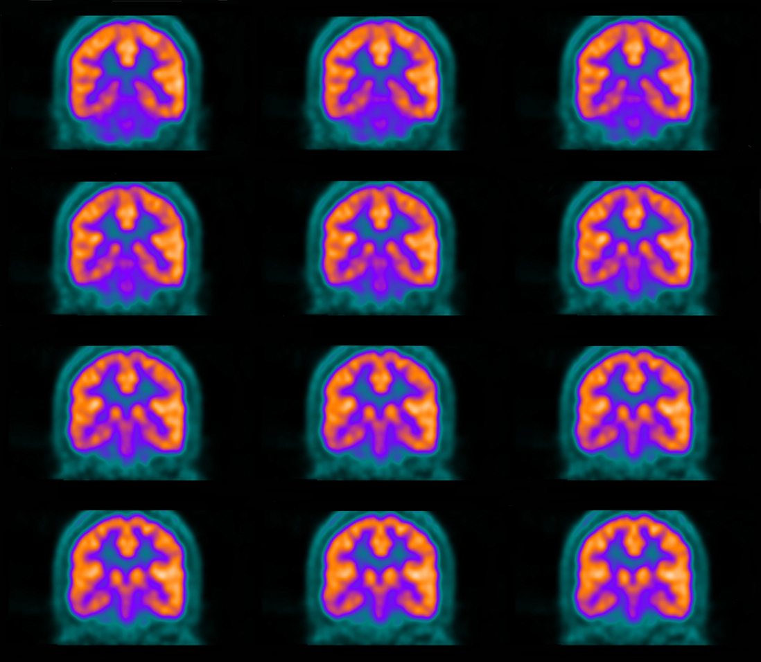 Пэт головного мозга. Позитронно-эмиссионная томография головного мозга. Позитронно-эмиссионная томография (ПЭТ) снимки с Альцгеймера. Позитронно-эмиссионная томография хореи Гентингтона. ПЭТ И ОФЭКТ мозга.